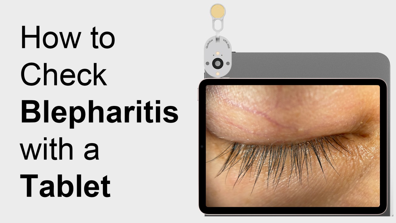 So überprüfen Sie Blepharitis mit einem Tablet