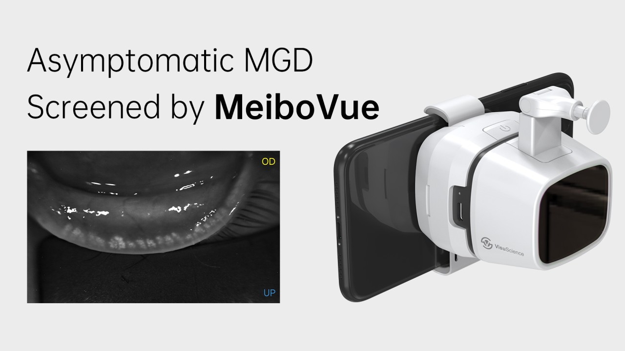 Asymptomatische MGD entdeckt von MeiboVue