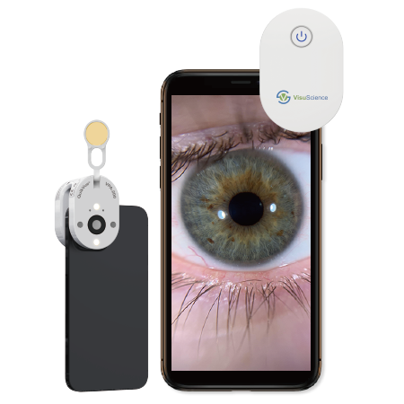 Ajustement de lentille sclérale avec adaptateur QuikVue