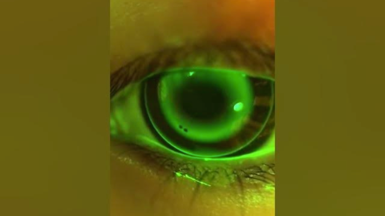 OK lens fitting video shot by QuikVue 