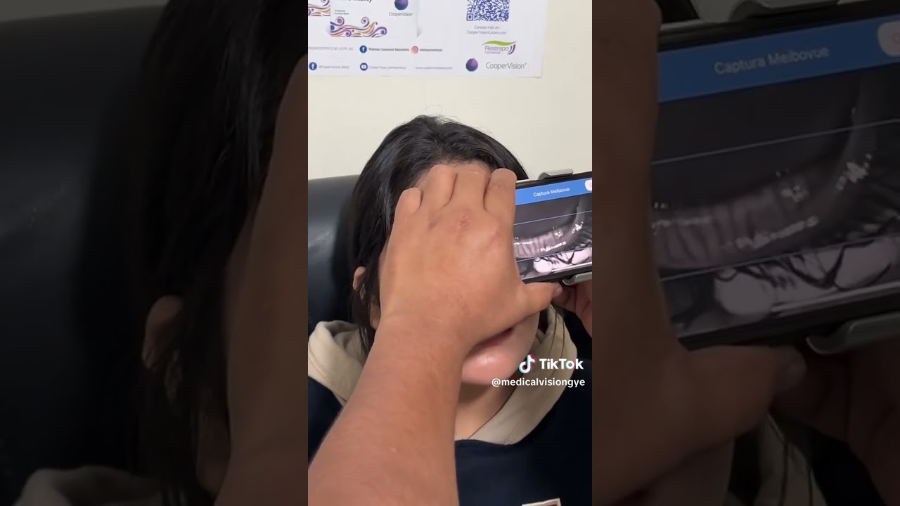 Utilisez MeiboVue pour informer le patient sur la sécheresse oculaire