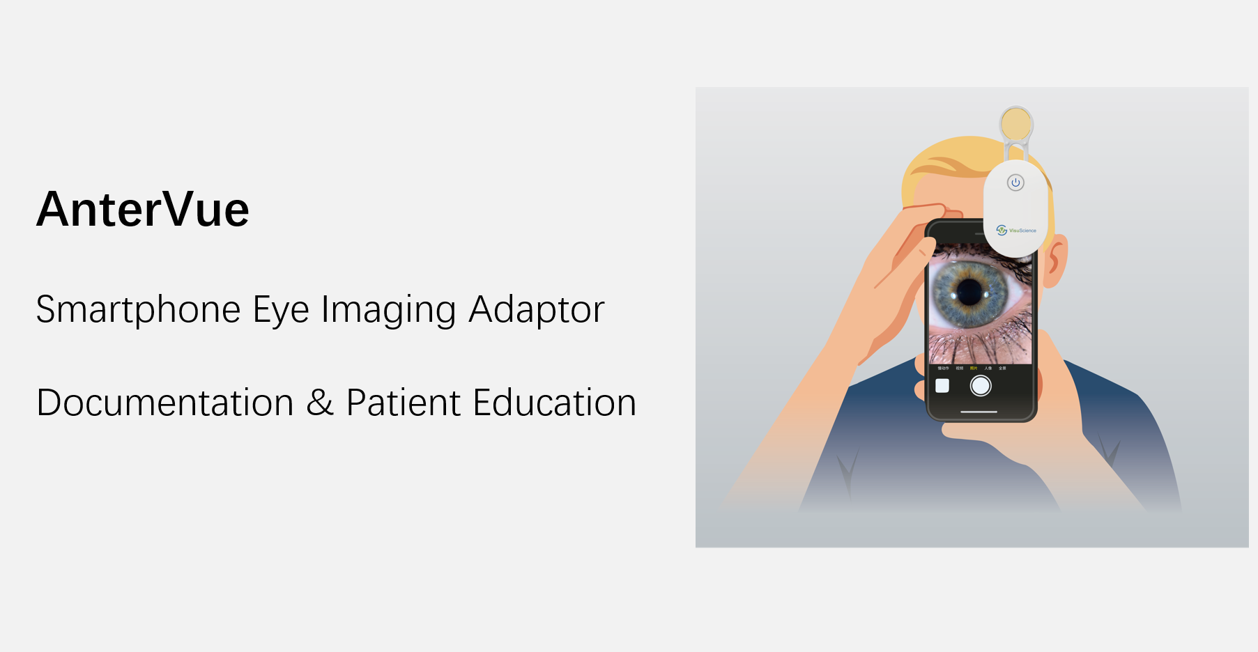 AnterVue: Turn Your Smartphone Into a Practical Anterior Segment Imaging Tool