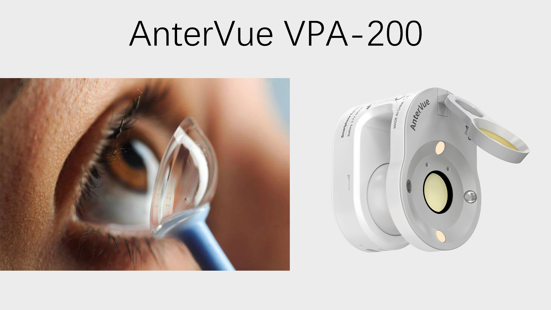 Four Cases: What AnterVue Imaging Can Help You Show