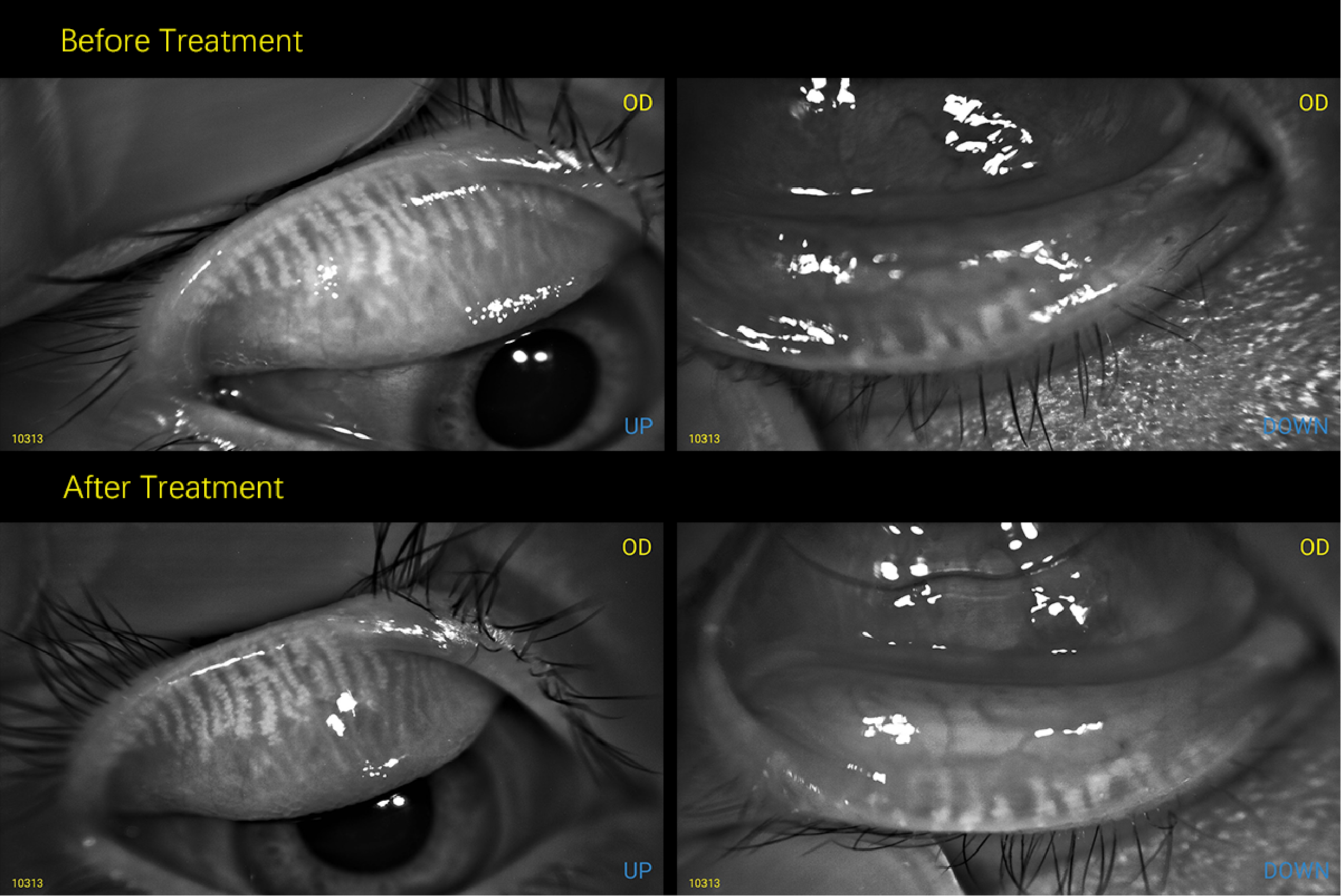 MeiboVue in Sjögren's Dry Eye: Tracking Severe Gland Dropout When Symptoms Improve