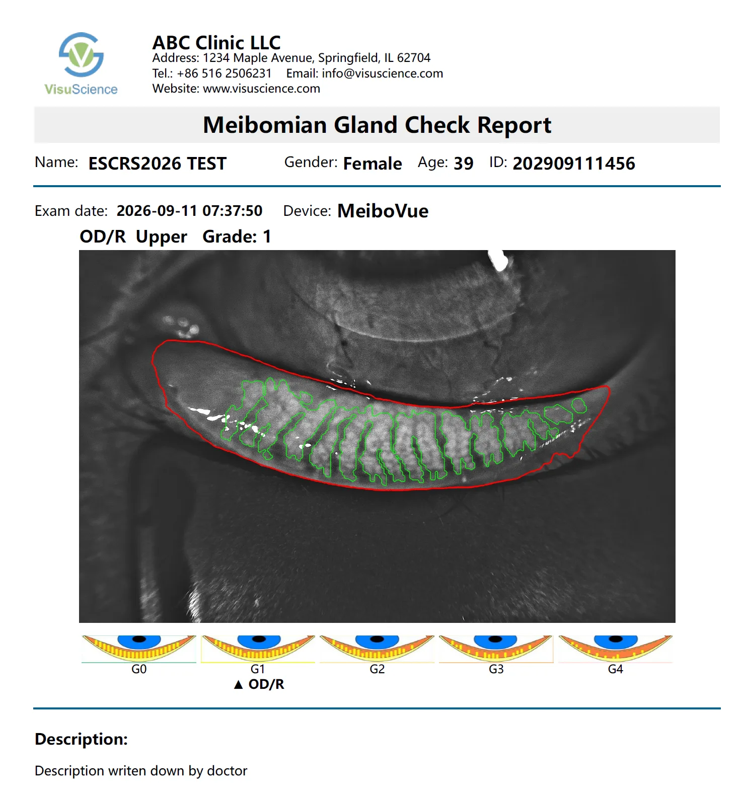 VisuDoc meibomian gland check report with images, grading and assessment